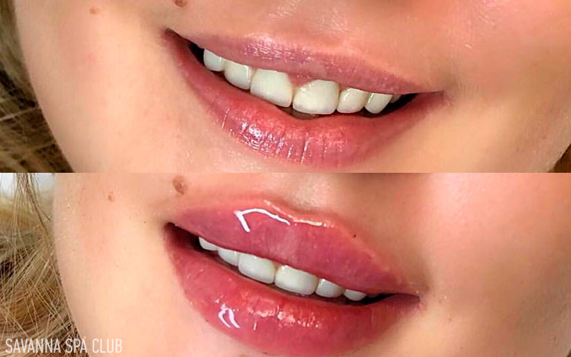 Збільшення губ (до і після процедури)
