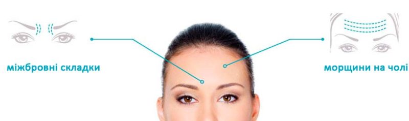 ботокс - відображення зон введення та ефекту на обличчі