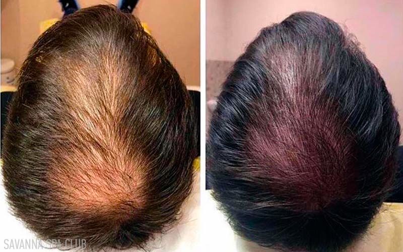 мезотерапія волосся, до/після процедури