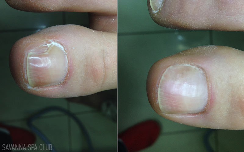 протезування нігтя гелем 